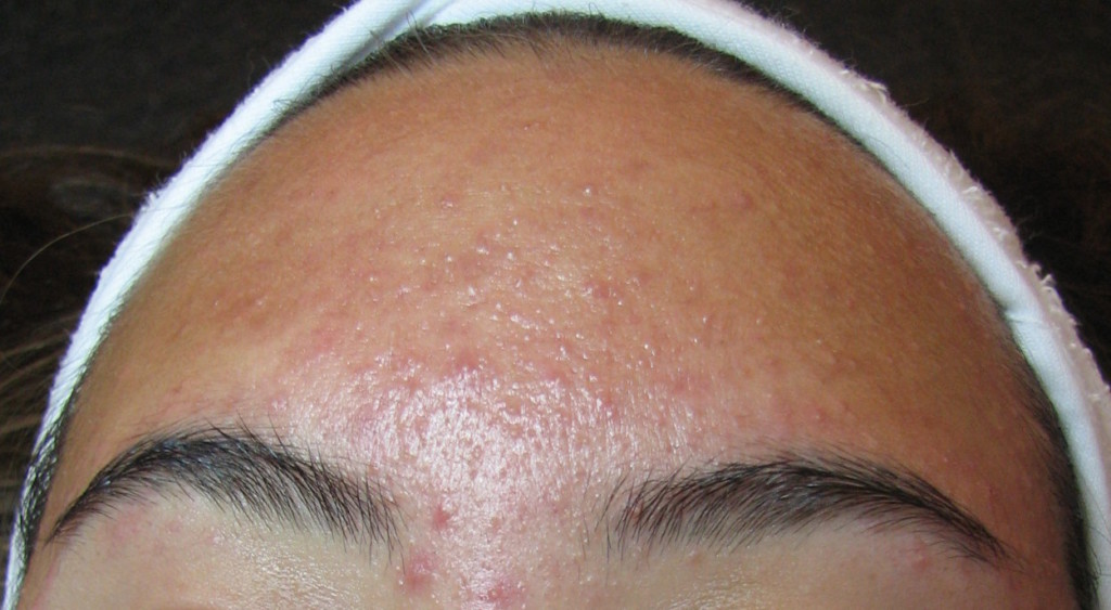 forehead-acne