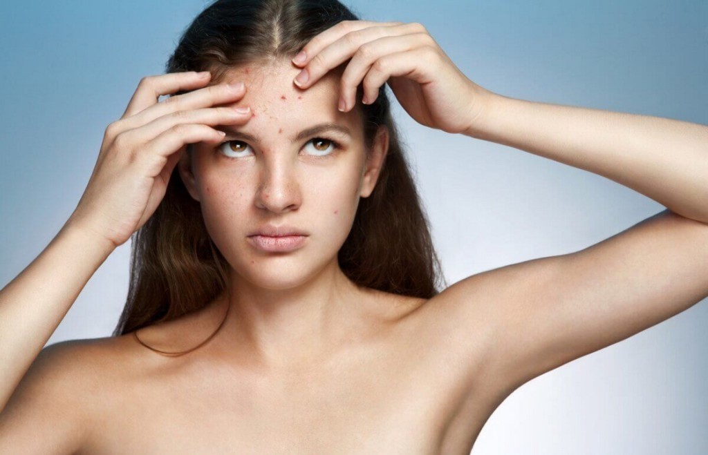 young girl with acne on her face