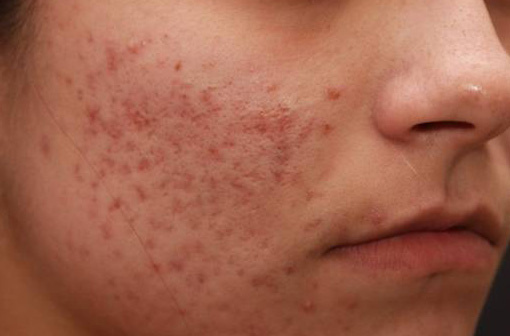 acne10 | Healthy Skin Journals