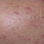 severe case of acne