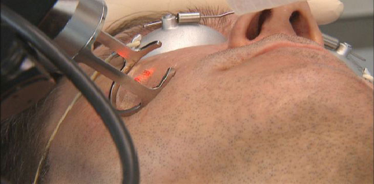 Acne-Laser-Treatment