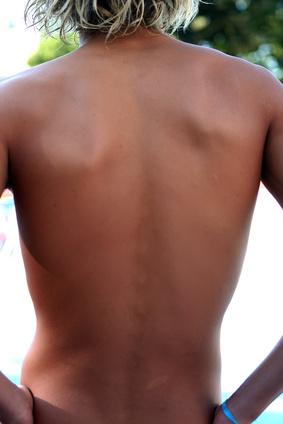 Back Acne